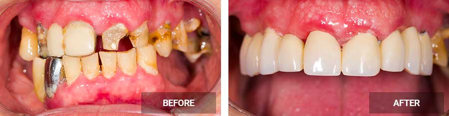 Dentures before after image Case 01