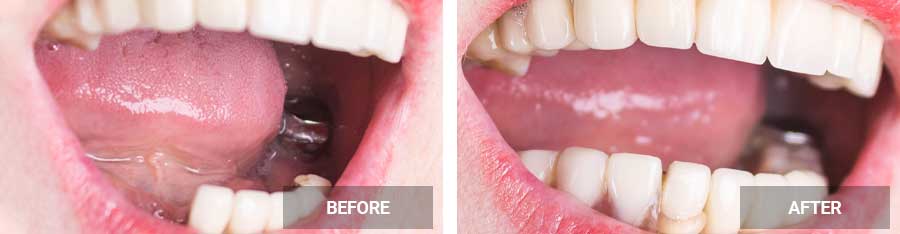 Dentures before after image Case 02