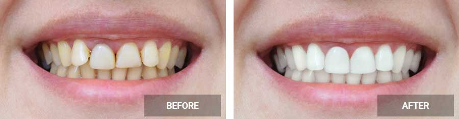 Teeth Whitening before after image case 02