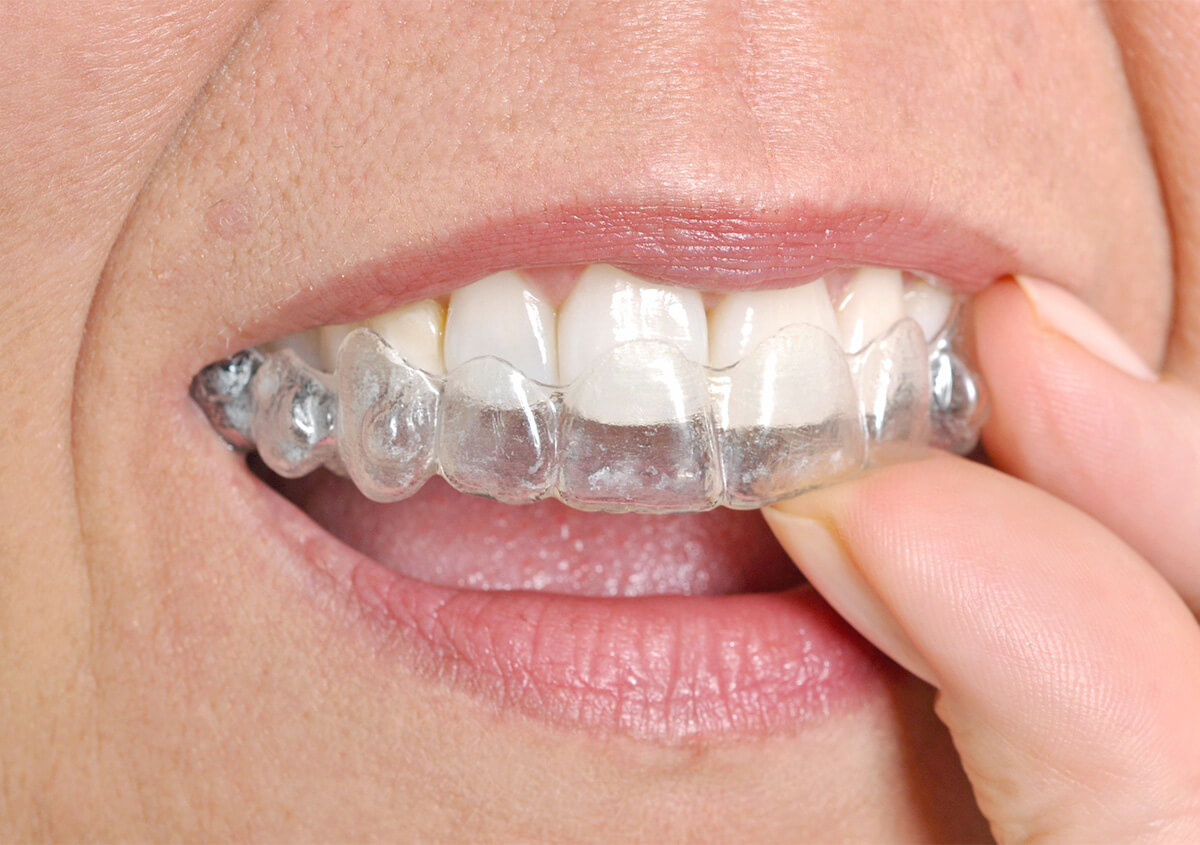 Invisalign for Adults in Chevy Chase MD Area